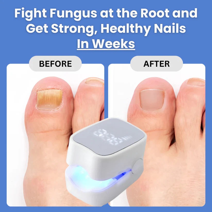 Sunbaz™ – Lasergerät gegen Nagelpilz