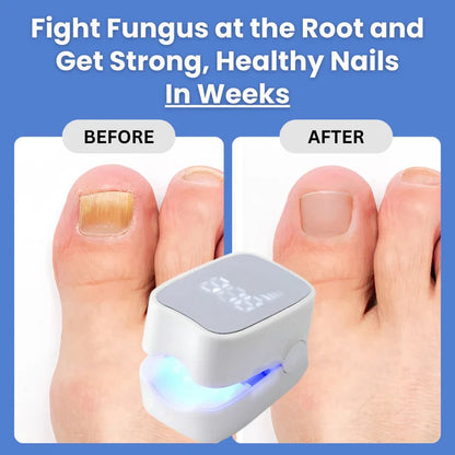 Sunbaz™ – Lasergerät gegen Nagelpilz