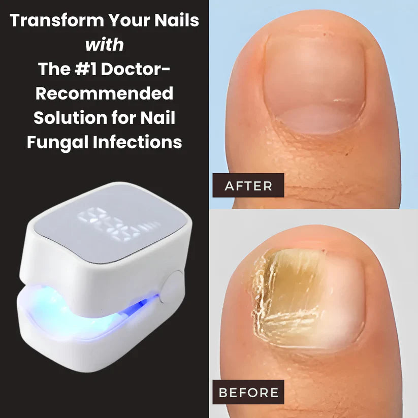 Sunbaz™ – Lasergerät gegen Nagelpilz