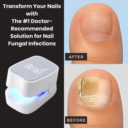 Sunbaz™ – Lasergerät gegen Nagelpilz